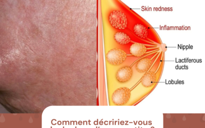 Comment décririez-vous la douleur d’une mastite ?