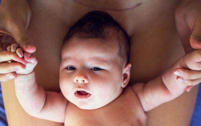 Projet de naissance en cas de césarienne